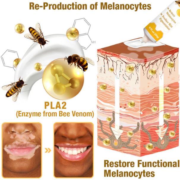Fivfivgo™ BeeVenom Vitiligo ( 7 Days Result ) Treatment Cream- BUY 1 GET 1 FREE ⭐️⭐️⭐️⭐️ 4.9/5 Reviews